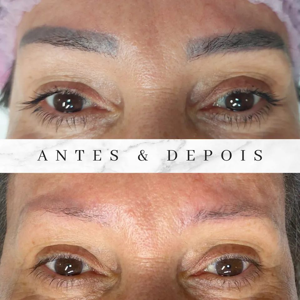 Foto de Remove Pigment – Remoção de Tatuagem a Laser em Foz do Iguaçu
